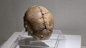 Tyrkisk svigermor, tyrkisk gift, Cappadocia, Kappadokien, rejs til Cappadocia fra Alanya, kør selv til Kappadokien, ferie med svigermor, Dansker i Tyrkiet, Cappadocia guide, Trepanering, oldtids trepanering,